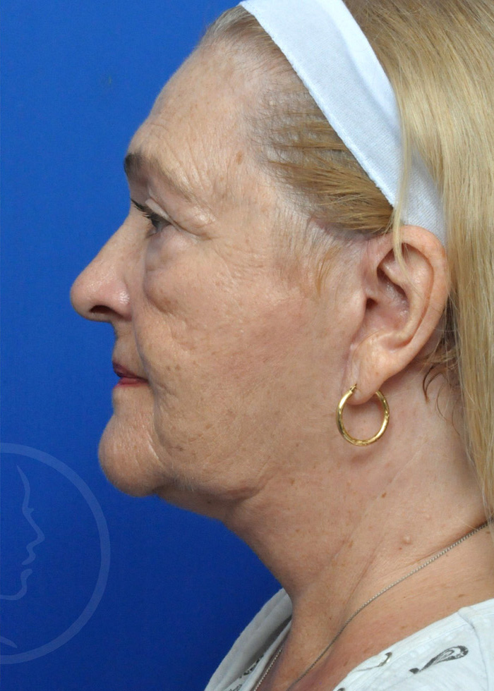 Facelift Before and After Pictures Jacksonville, FL