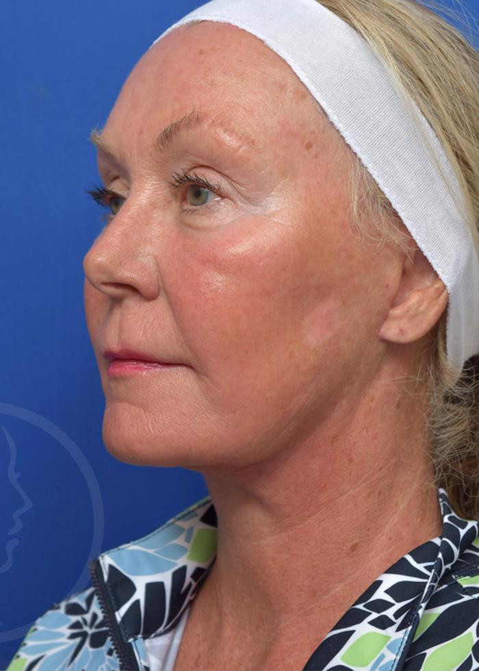 Facelift Before and After Pictures Jacksonville, FL