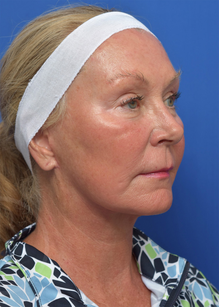 Facelift Before and After Pictures Jacksonville, FL