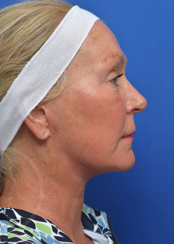 Facelift Before and After Pictures Jacksonville, FL