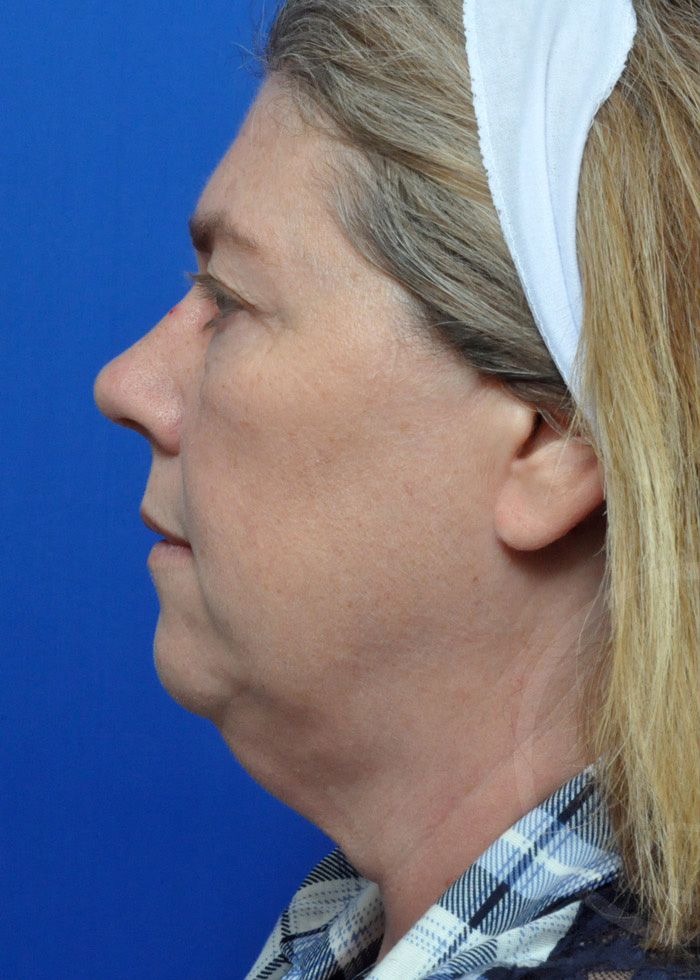 Facelift Before and After Pictures Jacksonville, FL