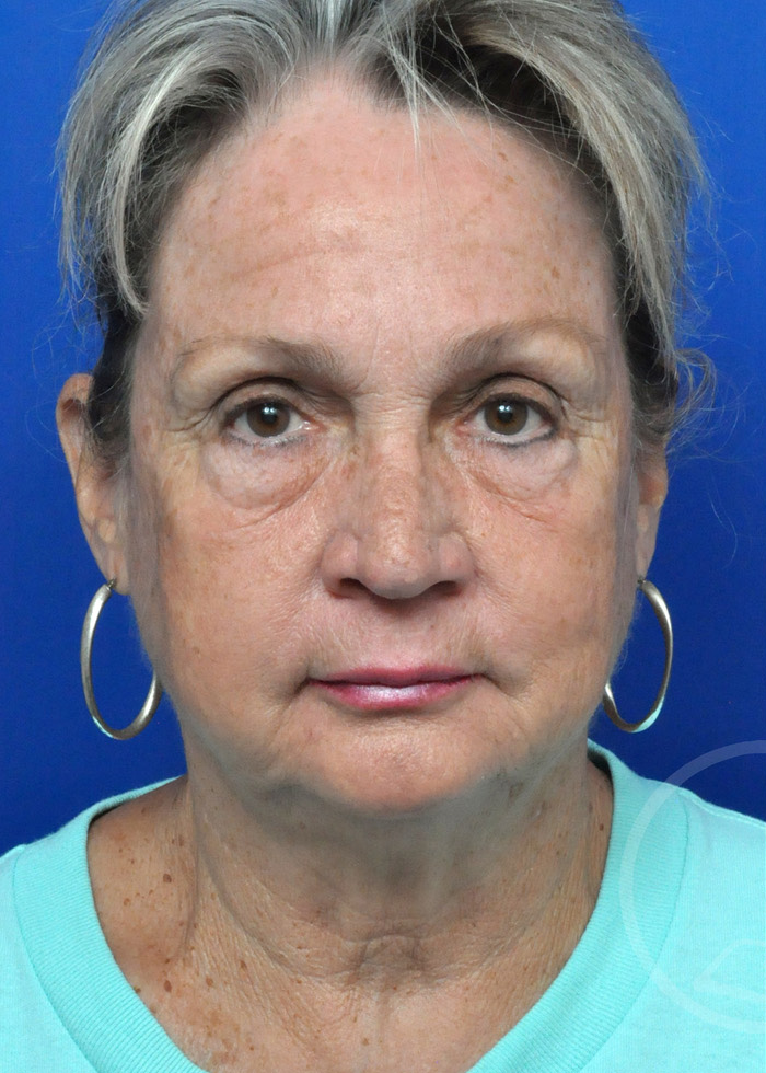 Facelift Before and After Pictures Jacksonville, FL