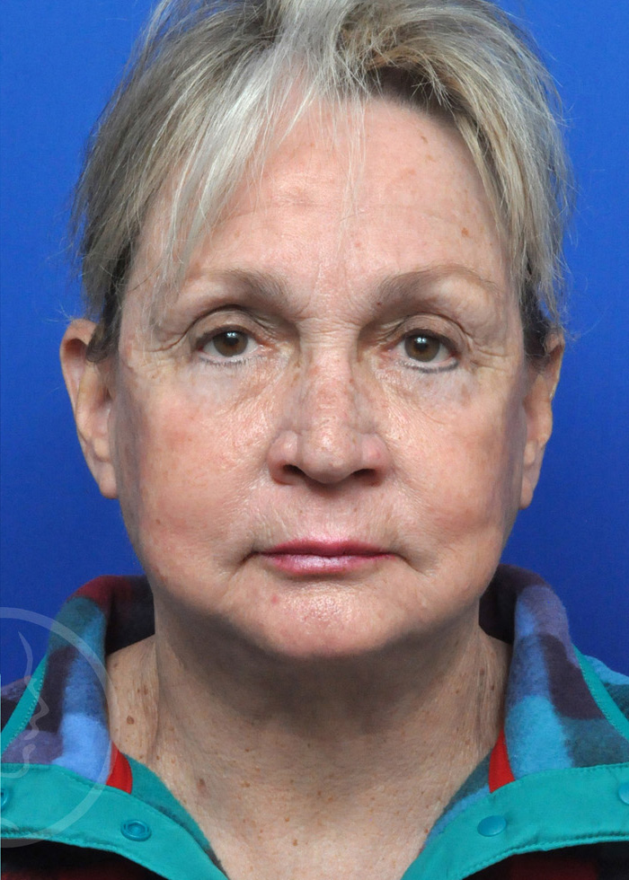 Facelift Before and After Pictures Jacksonville, FL