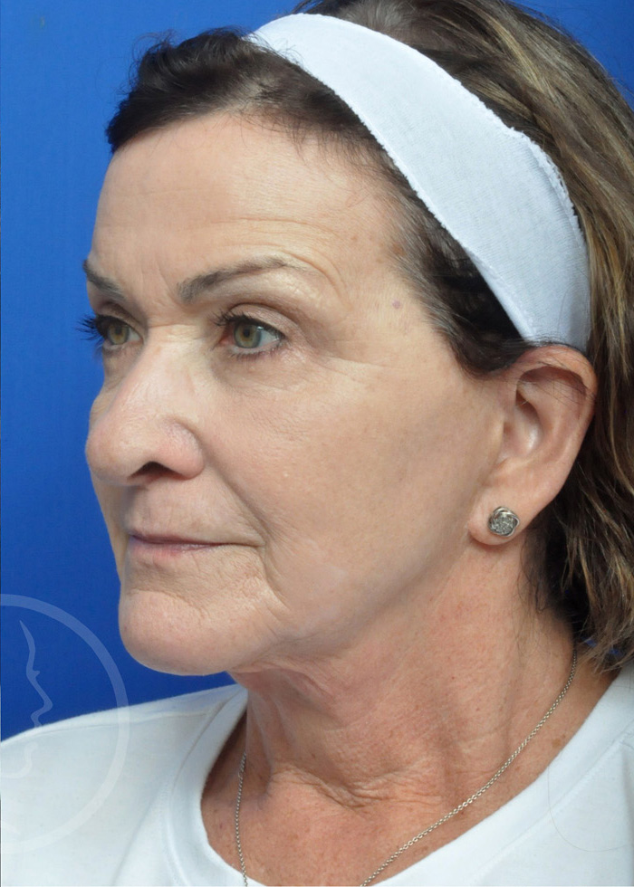 Facelift Before and After Pictures Jacksonville, FL