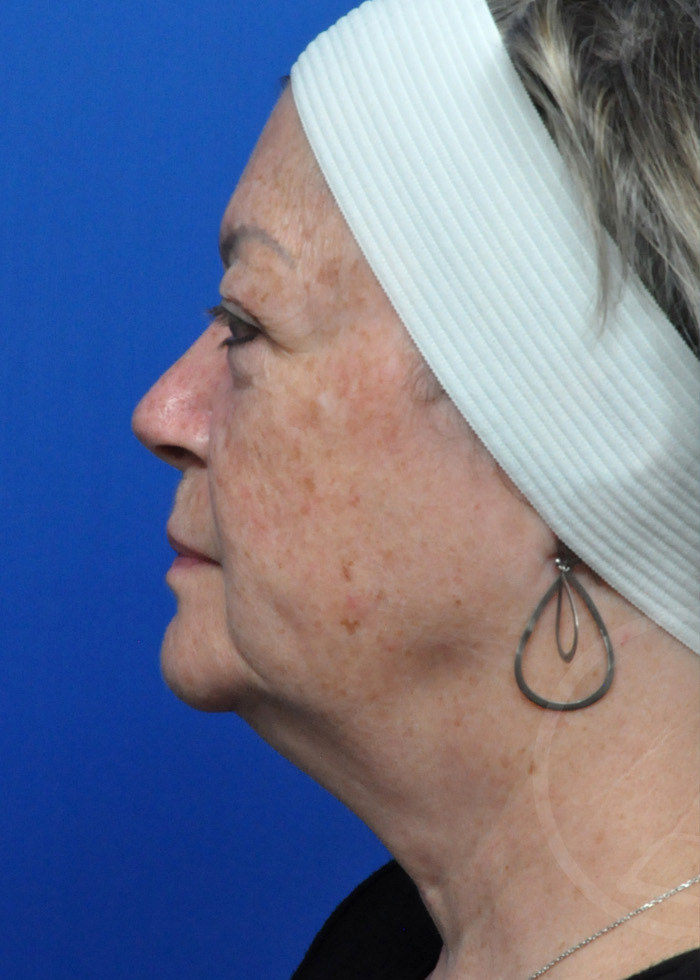 Facelift Before and After Pictures Jacksonville, FL