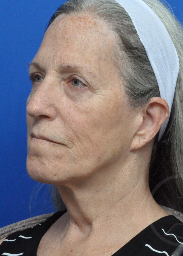 Facelift Before and After Pictures Jacksonville, FL