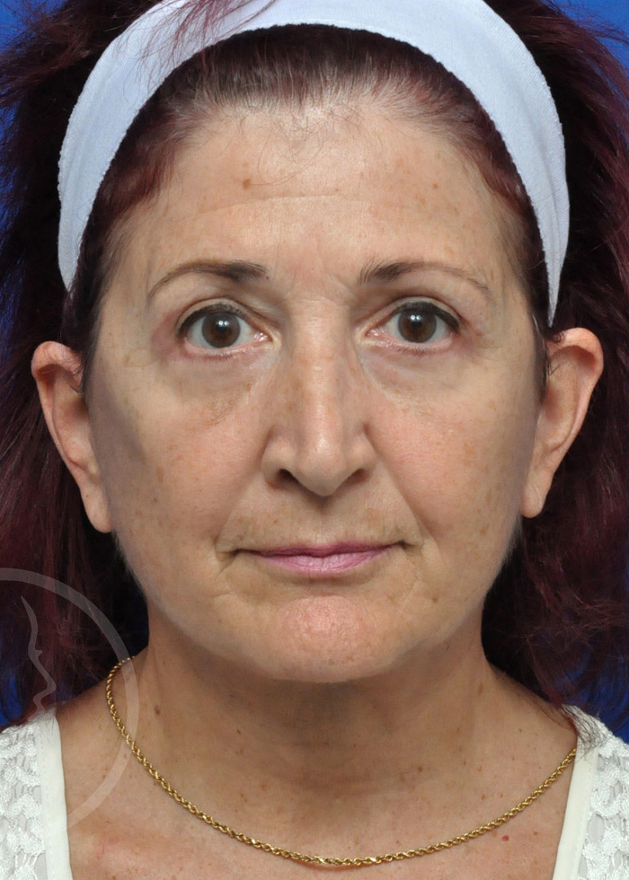 Facelift Before and After Pictures Jacksonville, FL