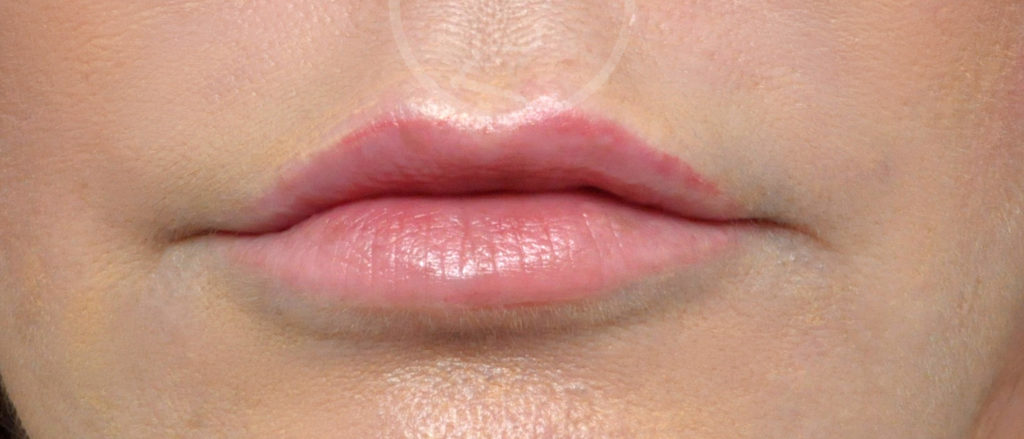 Lip Augmentation Before and After Pictures Jacksonville, FL