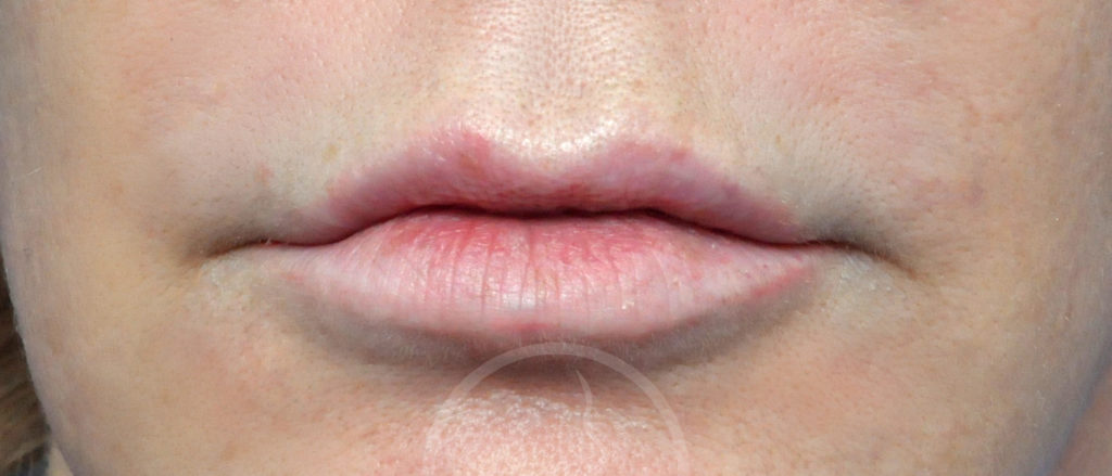 Lip Augmentation Before and After Pictures Jacksonville, FL