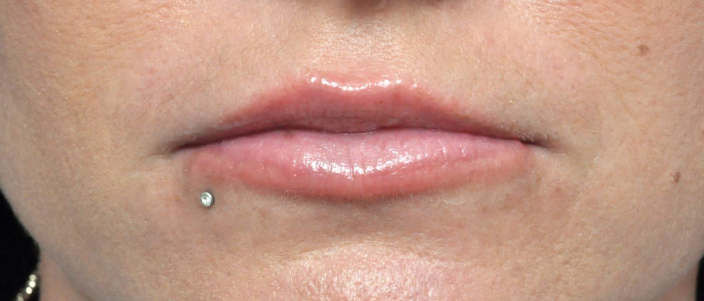 Lip Augmentation Before and After Pictures Jacksonville, FL