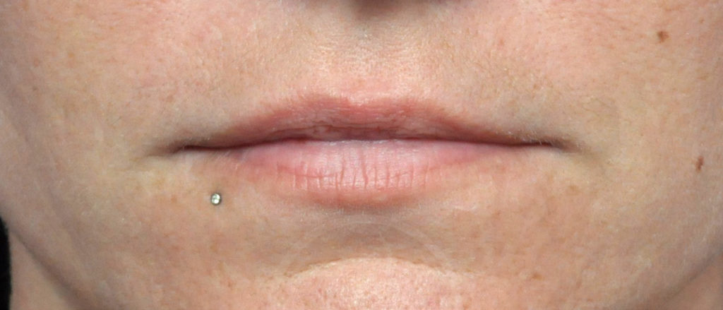 Lip Augmentation Before and After Pictures Jacksonville, FL