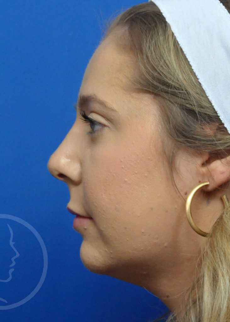 Rhinoplasty Before and After Pictures Jacksonville, FL