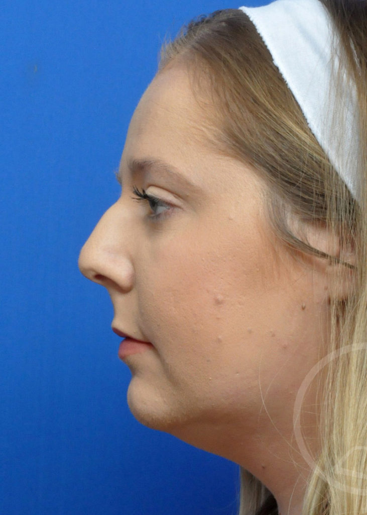 Rhinoplasty Before and After Pictures Jacksonville, FL