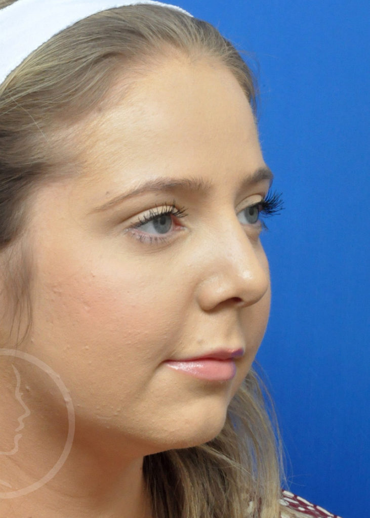 Rhinoplasty Before and After Pictures Jacksonville, FL