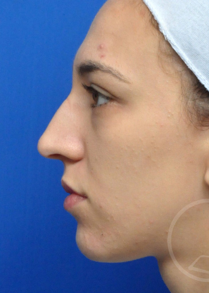 Rhinoplasty Before and After Pictures Jacksonville, FL