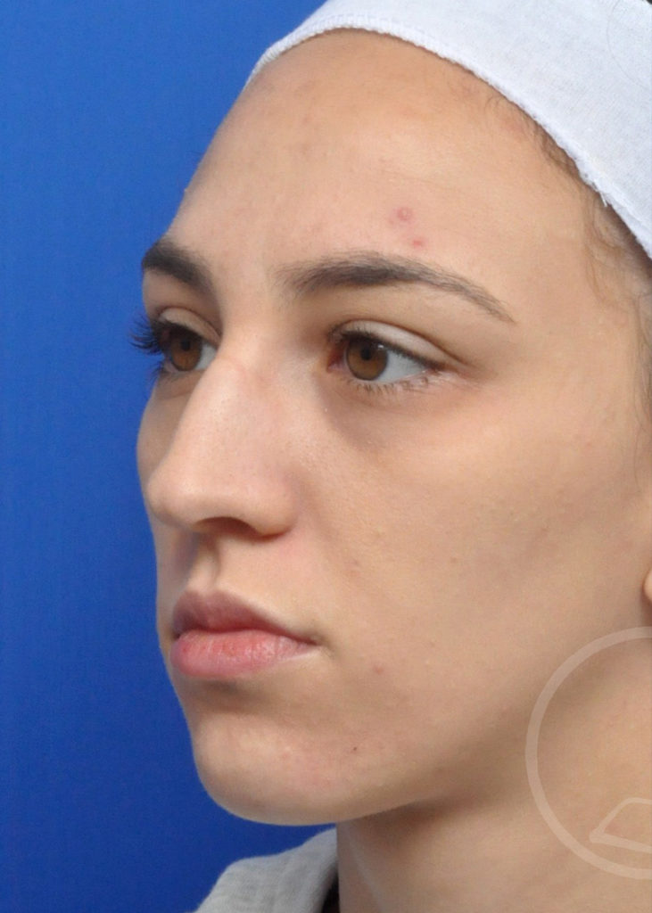 Rhinoplasty Before and After Pictures Jacksonville, FL