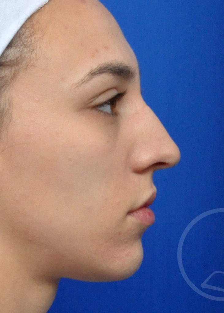 Rhinoplasty Before and After Pictures Jacksonville, FL