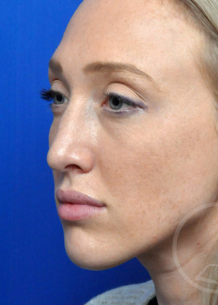 Rhinoplasty Before and After Pictures Jacksonville, FL