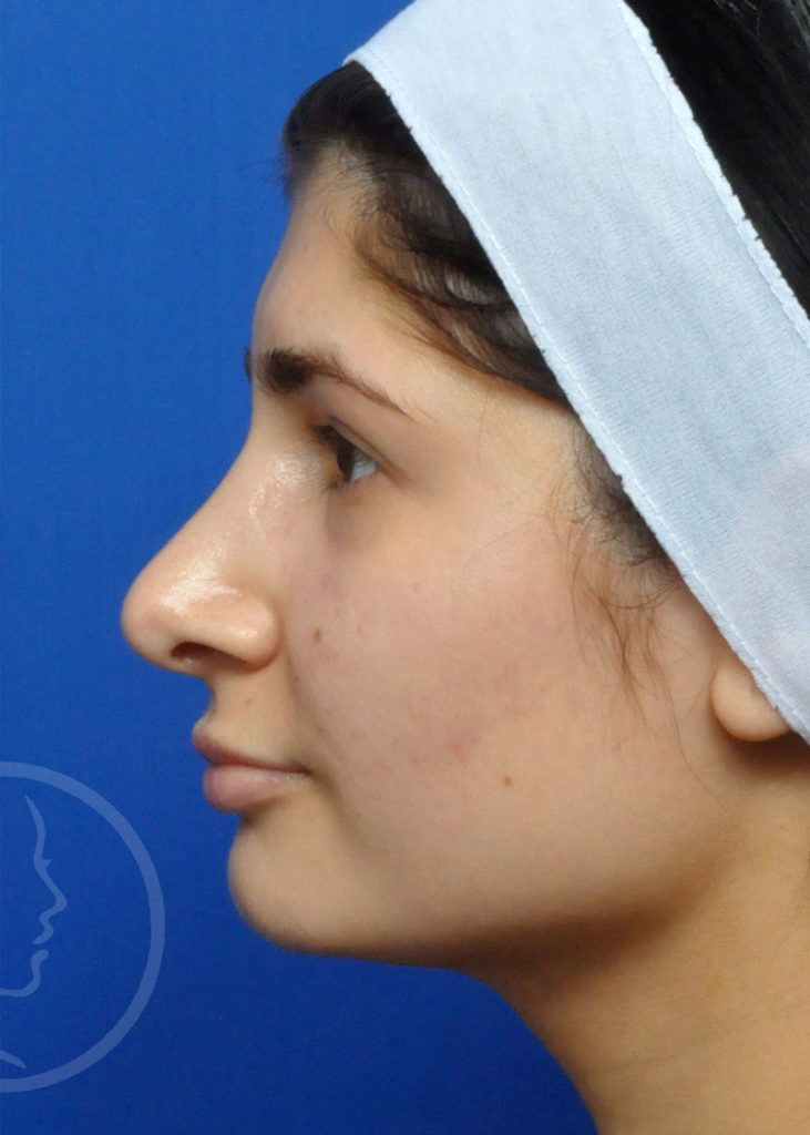 Rhinoplasty Before and After Pictures Jacksonville, FL