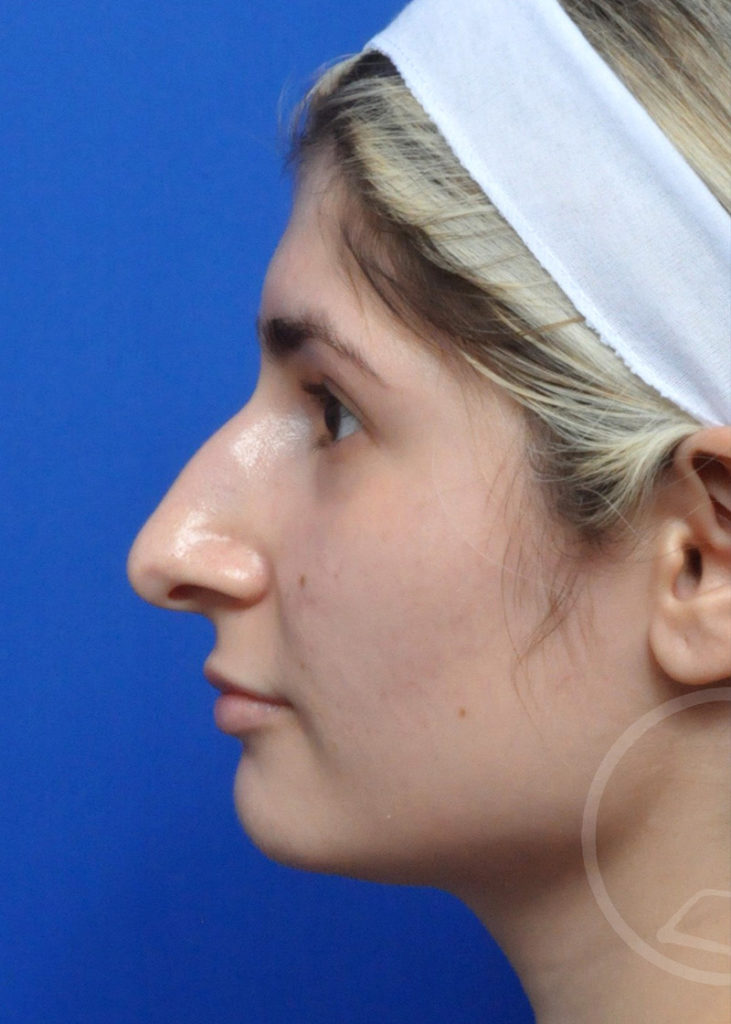 Rhinoplasty Before and After Pictures Jacksonville, FL