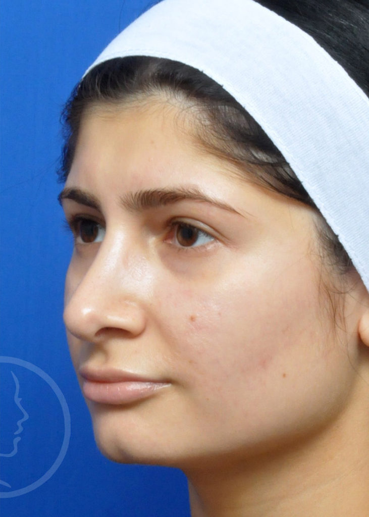 Rhinoplasty Before and After Pictures Jacksonville, FL