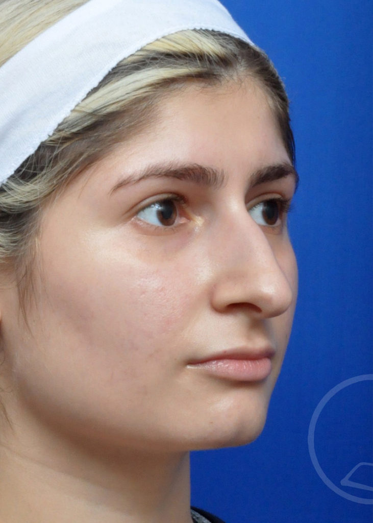 Rhinoplasty Before and After Pictures Jacksonville, FL