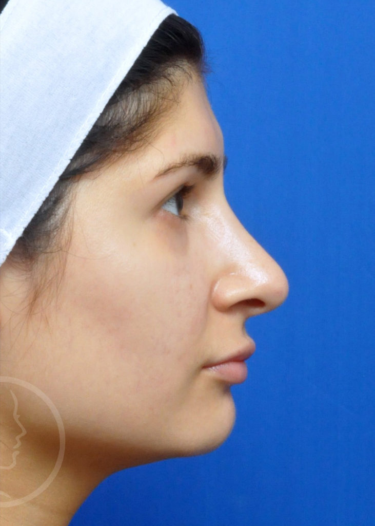 Rhinoplasty Before and After Pictures Jacksonville, FL