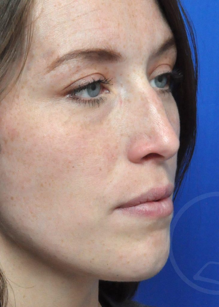 Rhinoplasty Before and After Pictures Jacksonville, FL