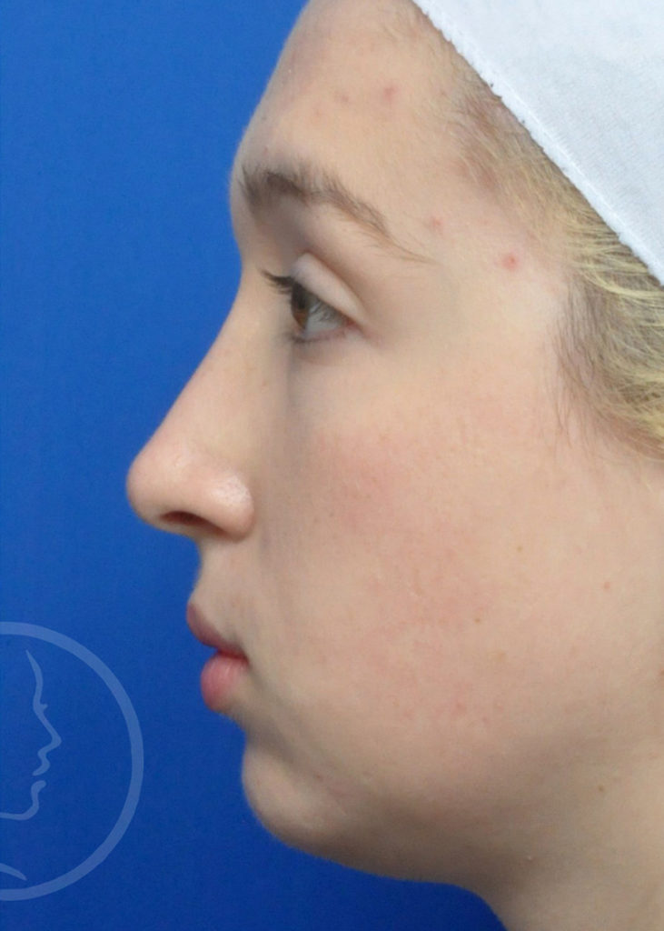 Rhinoplasty Before and After Pictures Jacksonville, FL