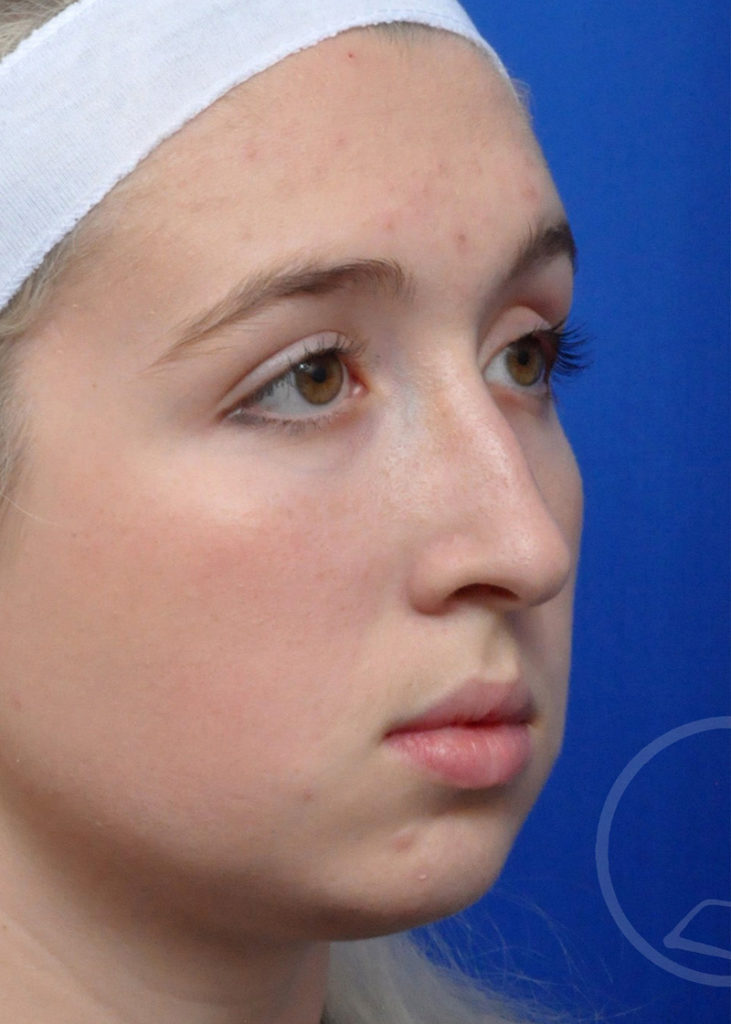 Rhinoplasty Before and After Pictures Jacksonville, FL