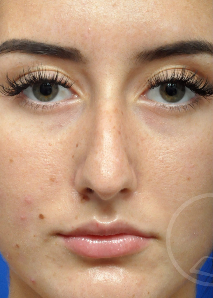 Rhinoplasty Before and After Pictures Jacksonville, FL