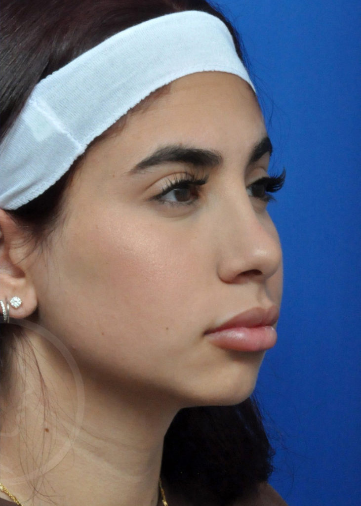 Rhinoplasty Before and After Pictures Jacksonville, FL