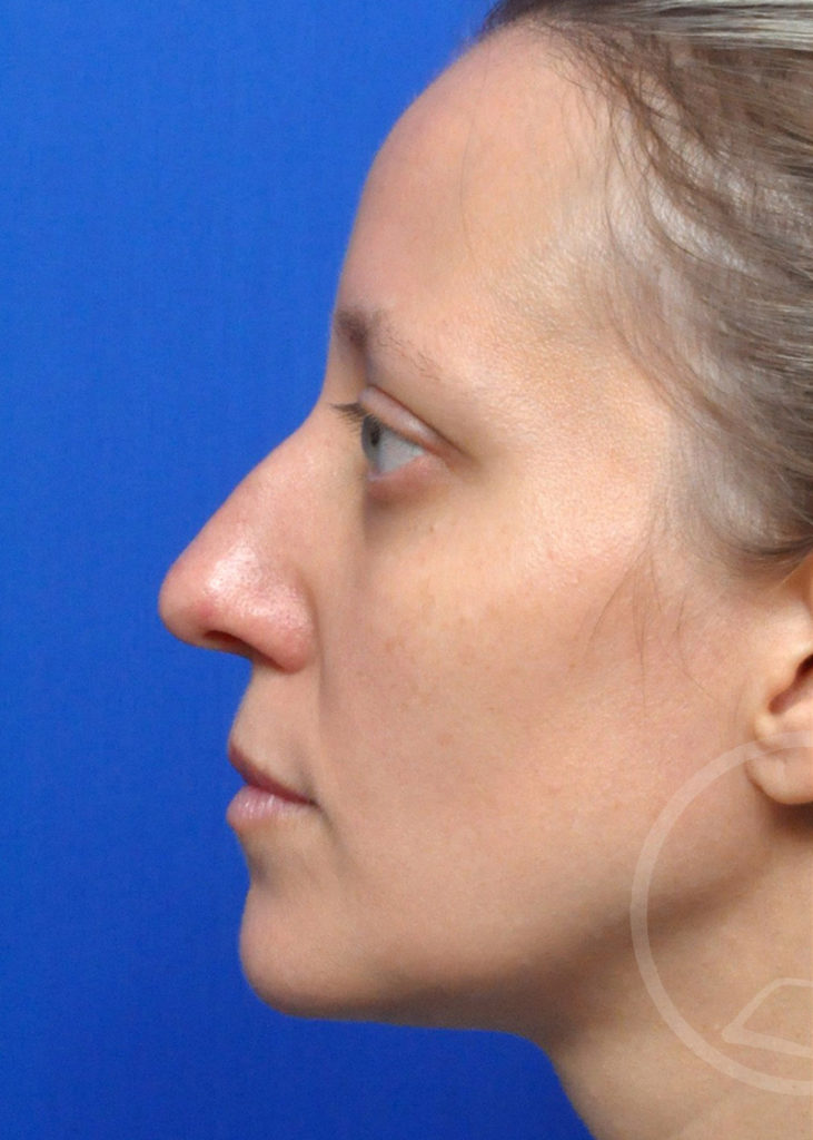 Rhinoplasty Before and After Pictures Jacksonville, FL