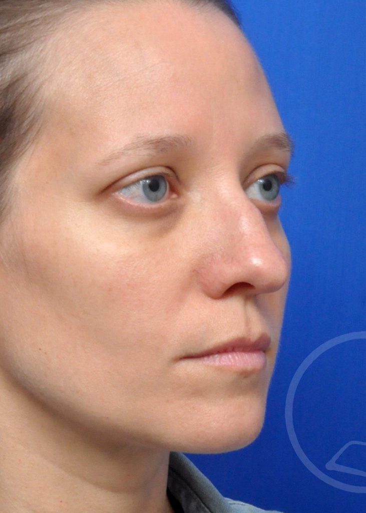 Rhinoplasty Before and After Pictures Jacksonville, FL