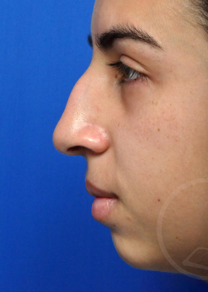 Rhinoplasty Before and After Pictures Jacksonville, FL