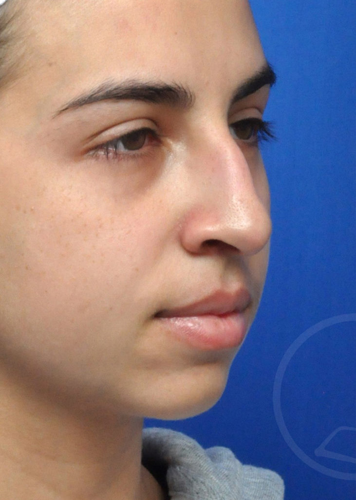 Rhinoplasty Before and After Pictures Jacksonville, FL