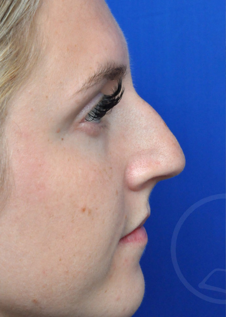 Rhinoplasty Before and After Pictures Jacksonville, FL