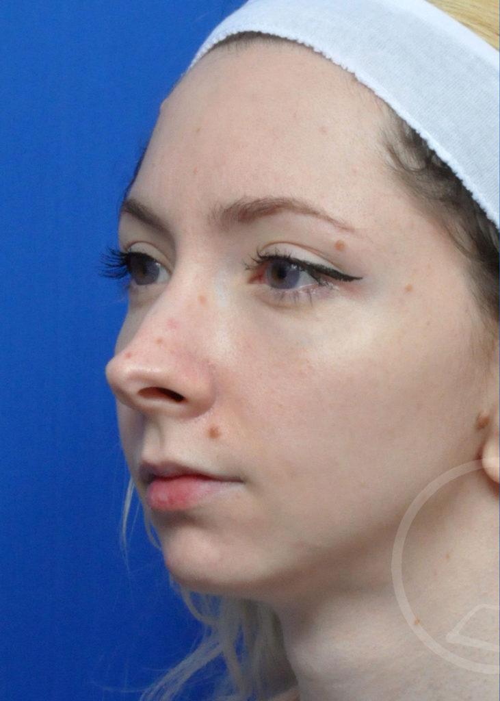 Rhinoplasty Before and After Pictures Jacksonville, FL