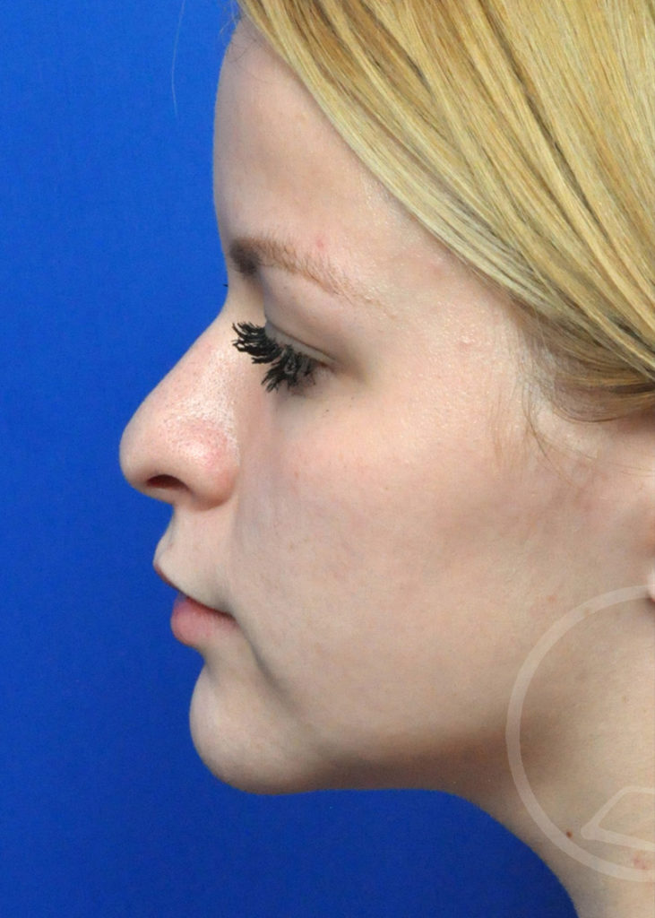 Rhinoplasty Before and After Pictures Jacksonville, FL