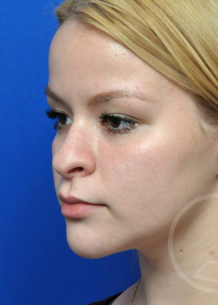 Rhinoplasty Before and After Pictures Jacksonville, FL