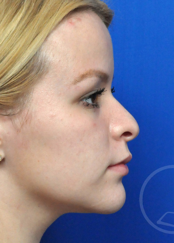 Rhinoplasty Before and After Pictures Jacksonville, FL