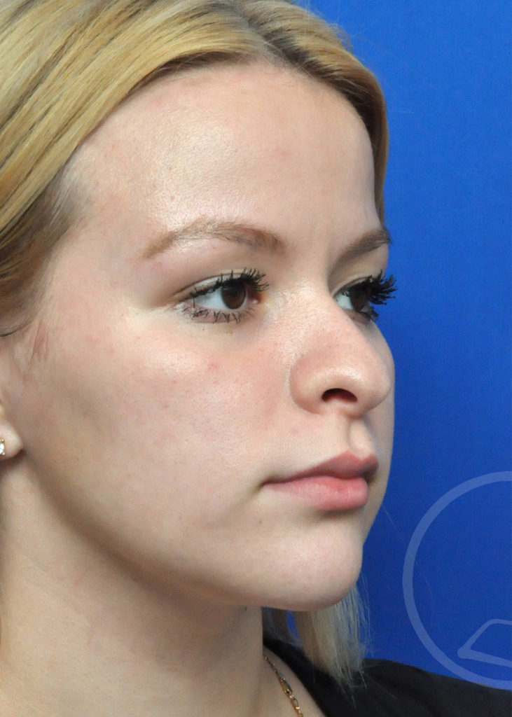 Rhinoplasty Before and After Pictures Jacksonville, FL