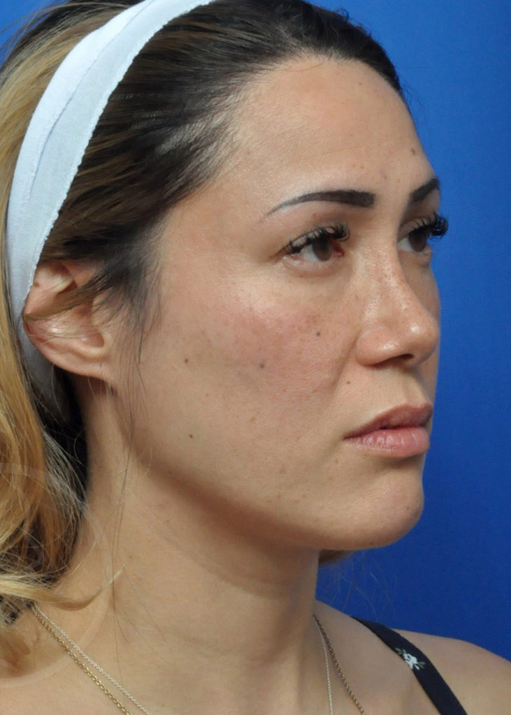 Rhinoplasty Before and After Pictures Jacksonville, FL