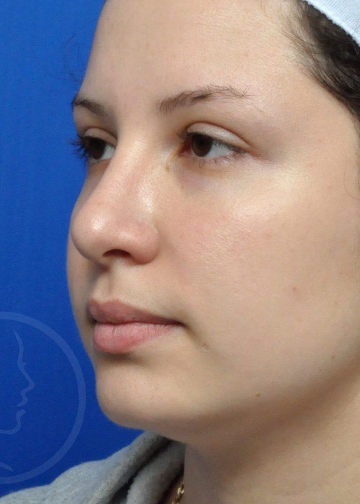 Rhinoplasty Before and After Pictures Jacksonville, FL