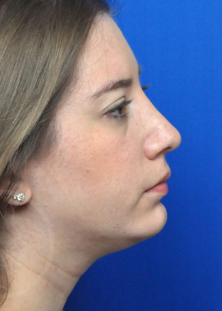 Rhinoplasty Before and After Pictures Jacksonville, FL