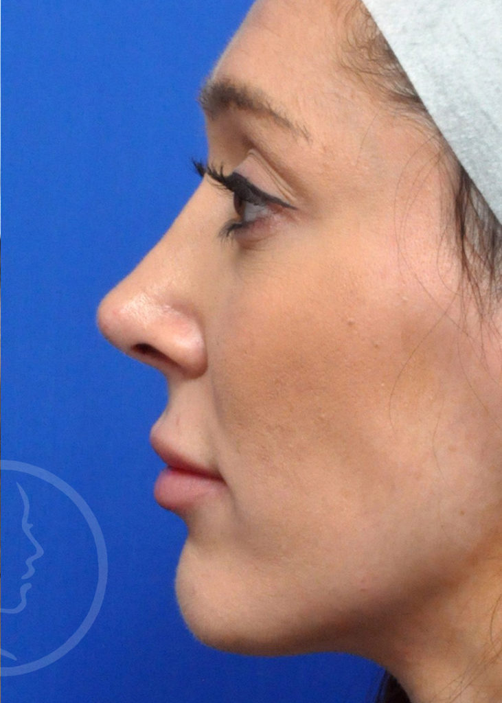 Rhinoplasty Before and After Pictures Jacksonville, FL