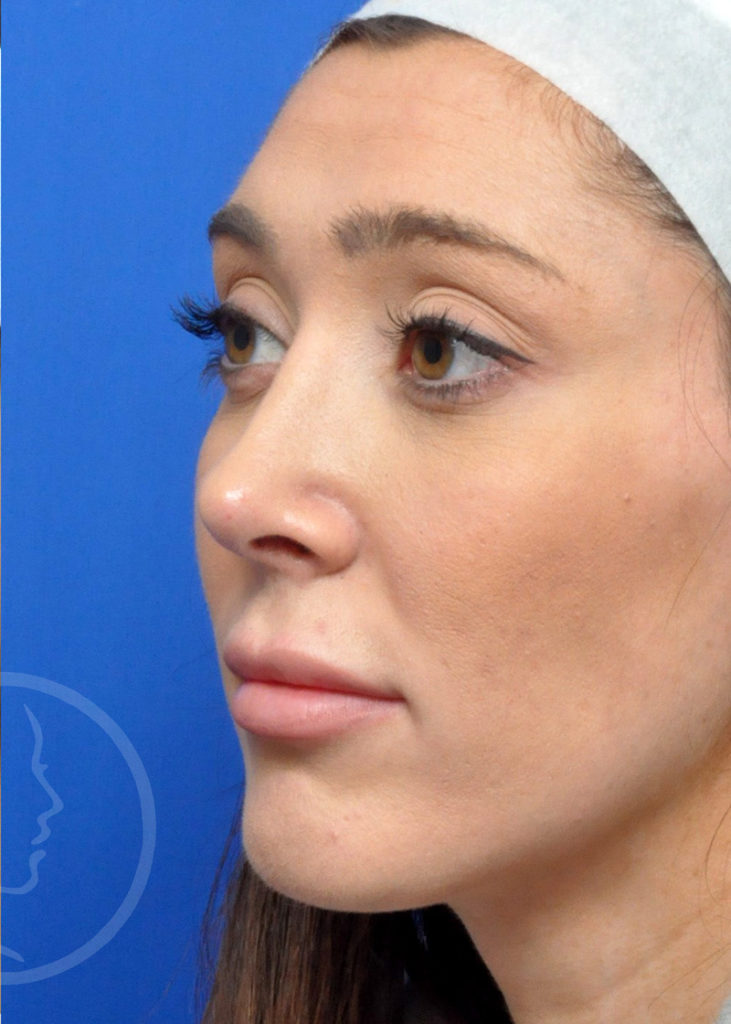 Rhinoplasty Before and After Pictures Jacksonville, FL