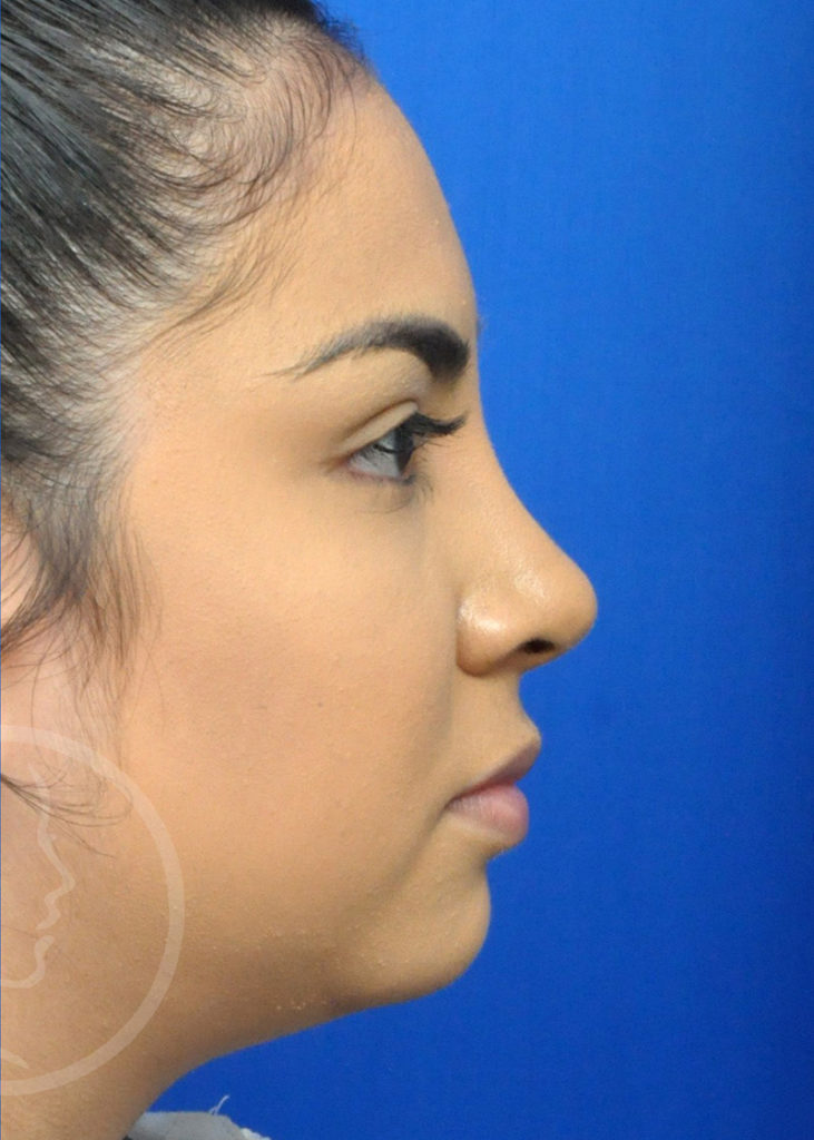 Rhinoplasty Before and After Pictures Jacksonville, FL