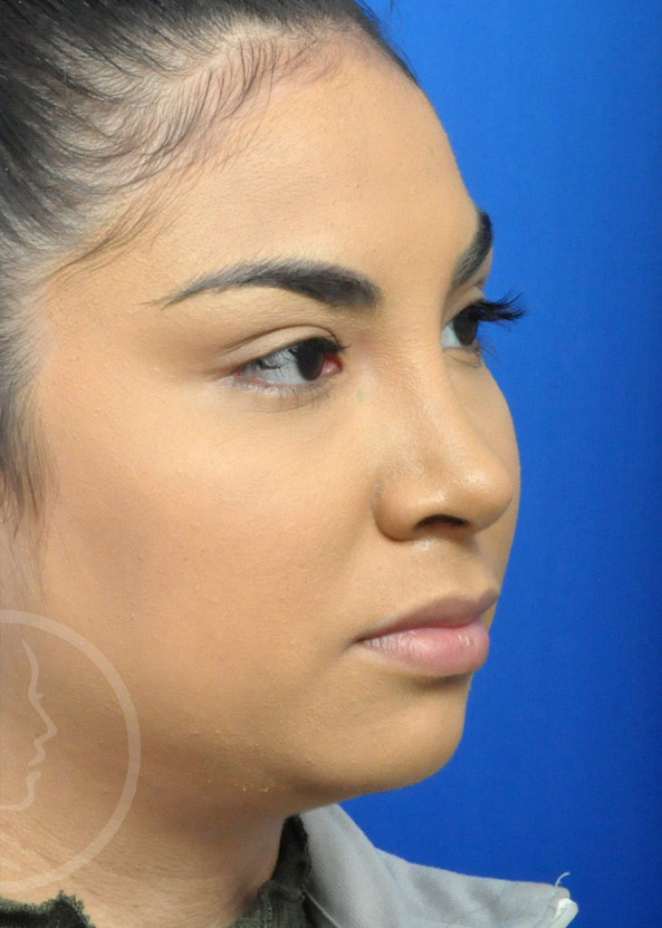 Rhinoplasty Before and After Pictures Jacksonville, FL