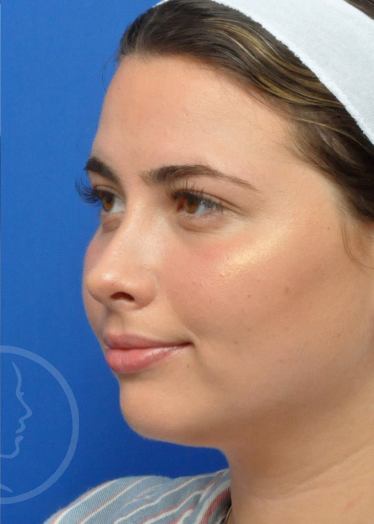 Rhinoplasty Before and After Pictures Jacksonville, FL